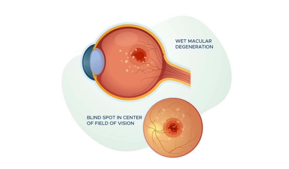 Illustration of wet macular degeneration showing central vision blind spot and retinal damage.